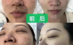 egf祛痘印效果怎样