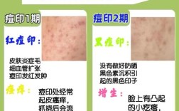 祛痘后红印怎么快速消除？