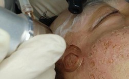 激光祛痘坑副作用有哪些？