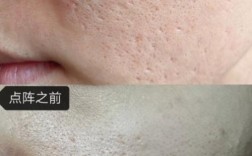 祛痘印激光还是光子更好？