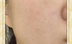 脸蜕皮，用什么护肤品修复好？