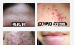 红霉素软膏祛痘会留疤吗？