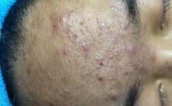 青春期祛痘 痘坑哪最