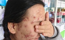 Clarisonic祛痘效果真的好吗？