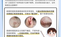 激光祛痘印会复发吗？