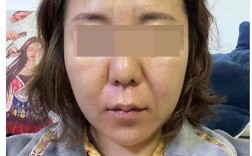 科瑞缇祛痘效果到底好不好？