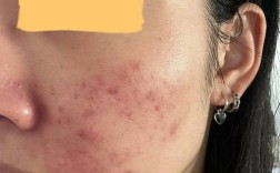 白醋祛痘方法是什么？