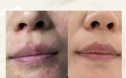 抗痘和祛痘，是一回事还是两回事？