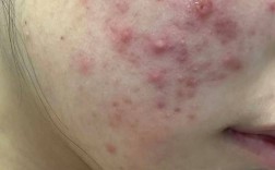 护肤品致痘？是产品问题还是肌肤排斥？