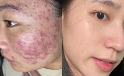 快速祛痘坑效果最好的方法是什么？