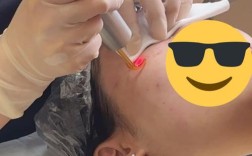 激光祛痘祛斑后，会反弹吗？