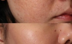 激光祛痘印效果到底怎么样？