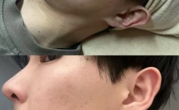 男生祛痘印美白，有哪些有效方法？