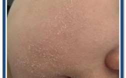 祛痘后皮肤发干怎么办？