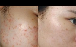 18岁去做激光祛痘好嘛