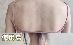 孕妇后背长痘怎么办？