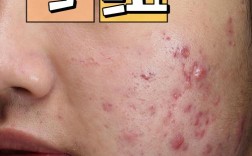 10%果酸真能祛痘坑吗？