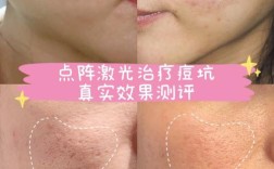 激光祛痘效果到底好不好？