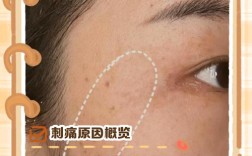 护肤品擦脸刺痛是过敏了吗？