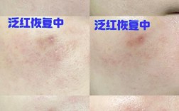 红蓝光祛痘会留疤吗？