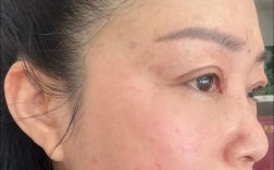 激光祛斑能同时祛痘印吗？