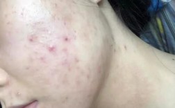 祛痘印痘坑，用什么最有效？