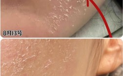 DHC祛痘精华蜕皮是正常反应吗？