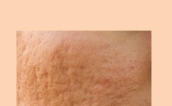 生姜祛痘印的原理是什么？