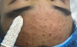 彻底祛痘 祛痘先补水