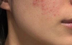 激光祛痘印效果真的好吗？