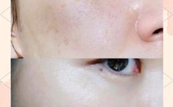 中药祛痘祛斑美白配方真的有效吗？