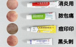 针排祛痘后，消炎产品怎么选？