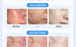 韩国祛痘药怎么买？