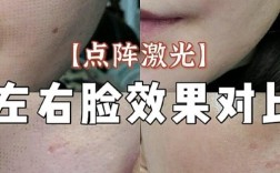 激光祛痘印去哪里做靠谱？