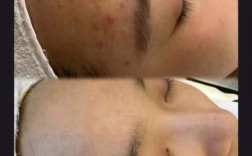 上海美莱激光祛痘效果真的显著吗？