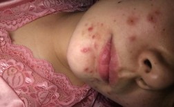 祛痘产品致痘起泡，是过敏还是刺激？