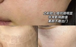 像素激光可以祛痘印吗