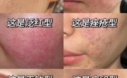 CPB护肤过敏了？原因是什么？