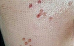 15岁可以做激光祛痘吗