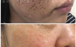激光祛痘坑后坑变大了