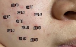 泡什么能祛痘祛印祛坑？