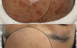 男士蜂毒祛痘净颜真的有效吗？