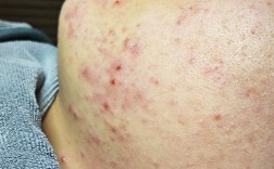 Jurlique祛痘效果真的好吗？