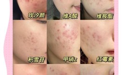 祛疤祛痘印用什么最好