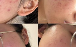 护肤品用后脸刺痛咋回事？