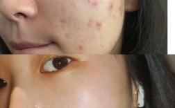 祛痘产品真有效？还是智商税？