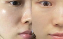 光子祛痘印后保湿该怎么做？