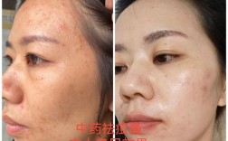 Dr.MJ祛痘粉末效果真的好吗？