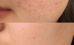 美容院祛痘真的会留痘印吗？