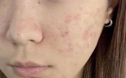 祛痘印产品用后反起痘，为何会这样？